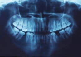 CEREC - Sedation Dentistry - Bonding - Bridges - Crowns - Dental Hygene - Teeth Whitening - Veneers - Dental Implants - Dentures - Exractions - Root Canals, Crown Lenghtening - Post Op Instructions - Framingham Dentists, Unique Dental of Framingham.
