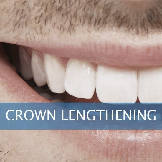 Crown Lenghtening - Post Op Instructions - Framingham Dentists, Unique Dental of Framingham.